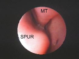 Septal Spur 